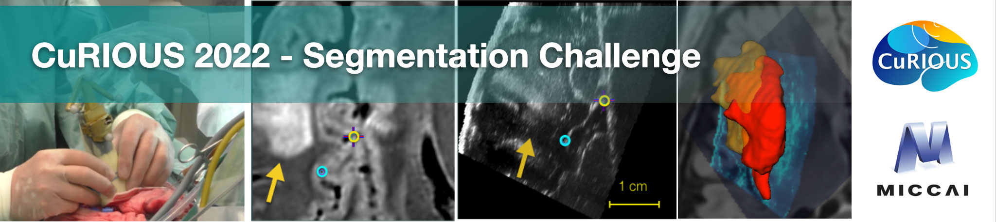 Brain shift with Intraoperative Ultrasound - Segmentation tasks Banner