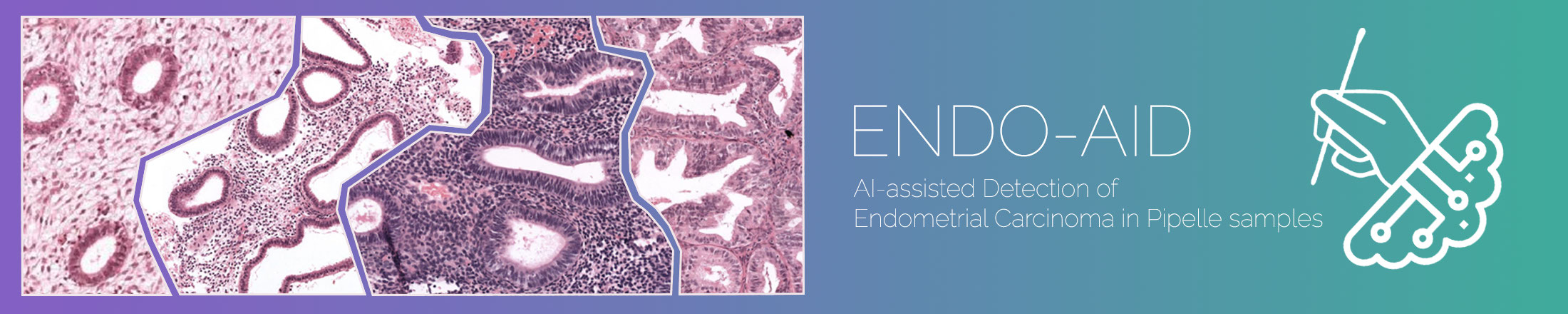 Endometrial Carcinoma Detection in Pipelle biopsies Banner