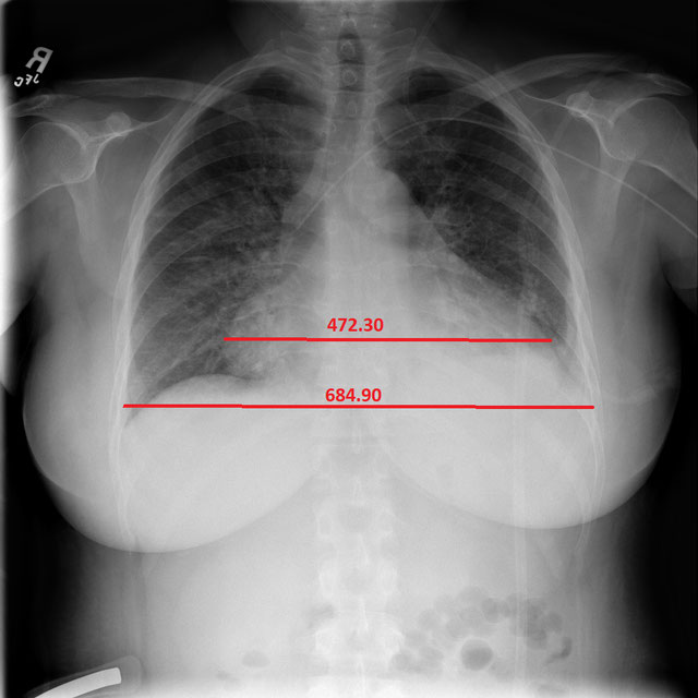 CXR Cardiomegaly Detection Logo