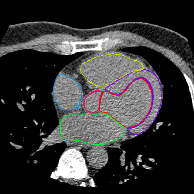 Whole-heart segmentation in non-contrast-enhanced CT Logo