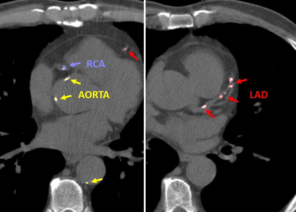 Logo for Calcium scoring in non-contrast CT showing the heart