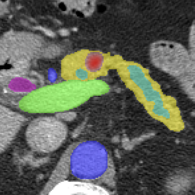 Pancreatic Ductal Adenocarcinoma Detection in CT Logo