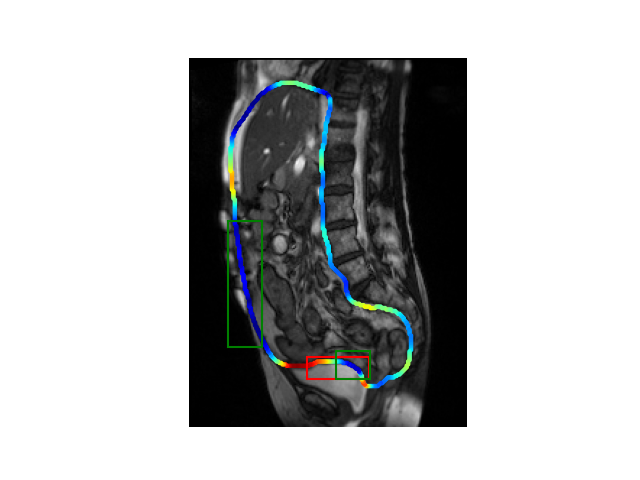 Logo for Visceral slide on abdominal cine-MRI