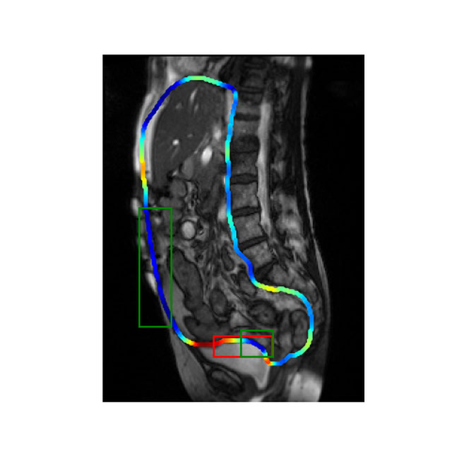 Visceral slide on abdominal cine-MRI Logo