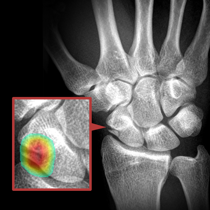 Logo for Scaphoid fracture detection