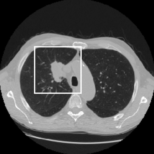 Lung cancer risk estimation on thorax CT scans - DSB2017 JulianDaniel Logo
