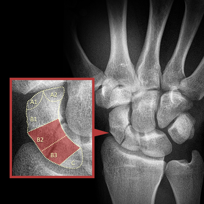 Logo for Multi-view scaphoid fracture detection