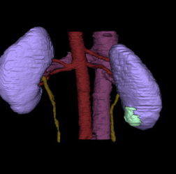 Logo for Automatic segmentation of kidney, tumor and cysts