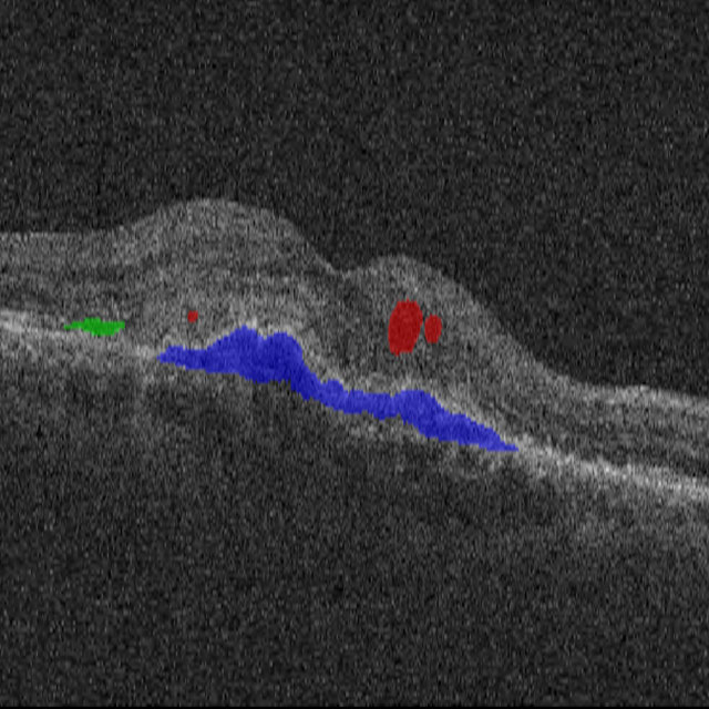 Fluid Segmentation in Retinal Optical Coherence Tomography (OCT) Logo