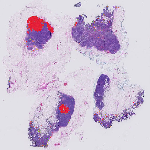 Tumor Detection in Lymph Nodes Logo