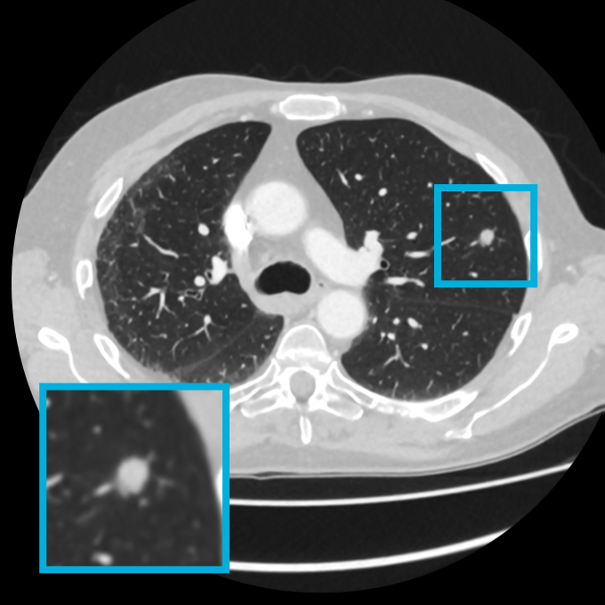Logo for Lung nodule detection for routine clinical CT scans