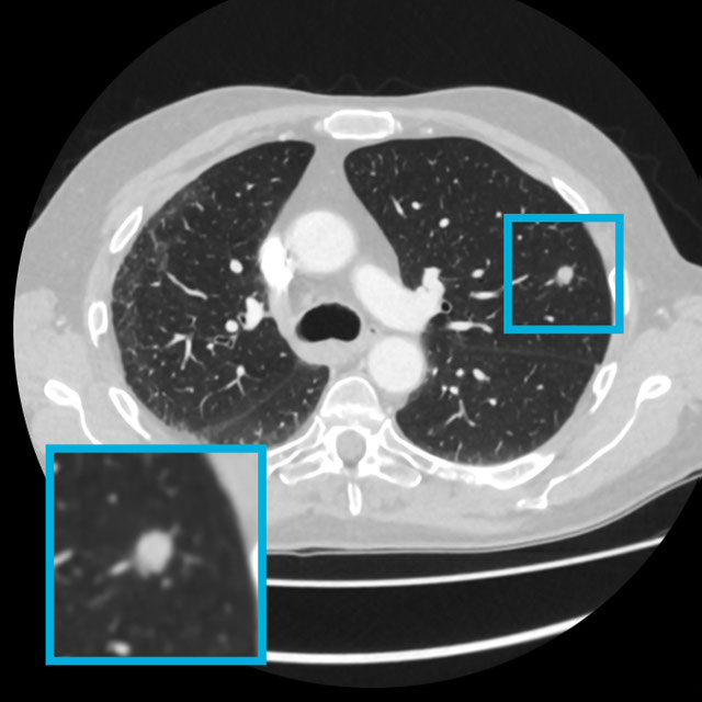 Lung nodule detection for routine clinical CT scans Logo